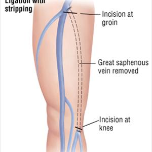 Prevent Varicose Veins - Sclerotherapy To Eliminate Spider And Varicose Veins