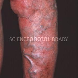 California Varicose Veins - Varicose Vein Removal, The Twisted Problem