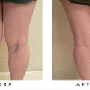 Tortuous Varicose Veins - Important Facts About Varicose Veins You Should Know