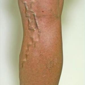 Varicose Medical Definition - Natural Care For Varicose Veins