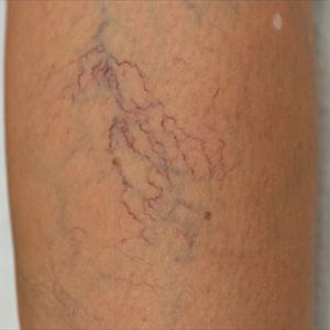 Vaginal Varicosities Csection - Sclerotherapy To Eliminate Spider And Varicose Veins