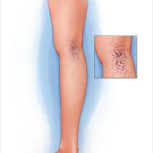  Varicose Veins: Causes & Prevention