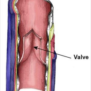 Foot Varicose Veins - Compression Stockings For Your Health