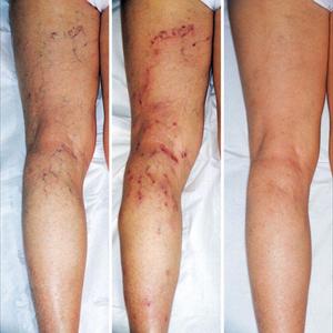 Varicose Veins Pictures - Natural Supplements And Vitamins For Varicose Veins