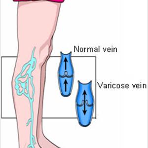 Testicle Varicose Veins 