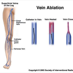 Varicose Veinsveins - Information On Varicose Veins