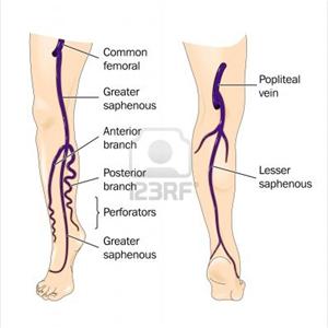 Varicose Vein Corrections - Non-Surgical Removal Of Spider Veins